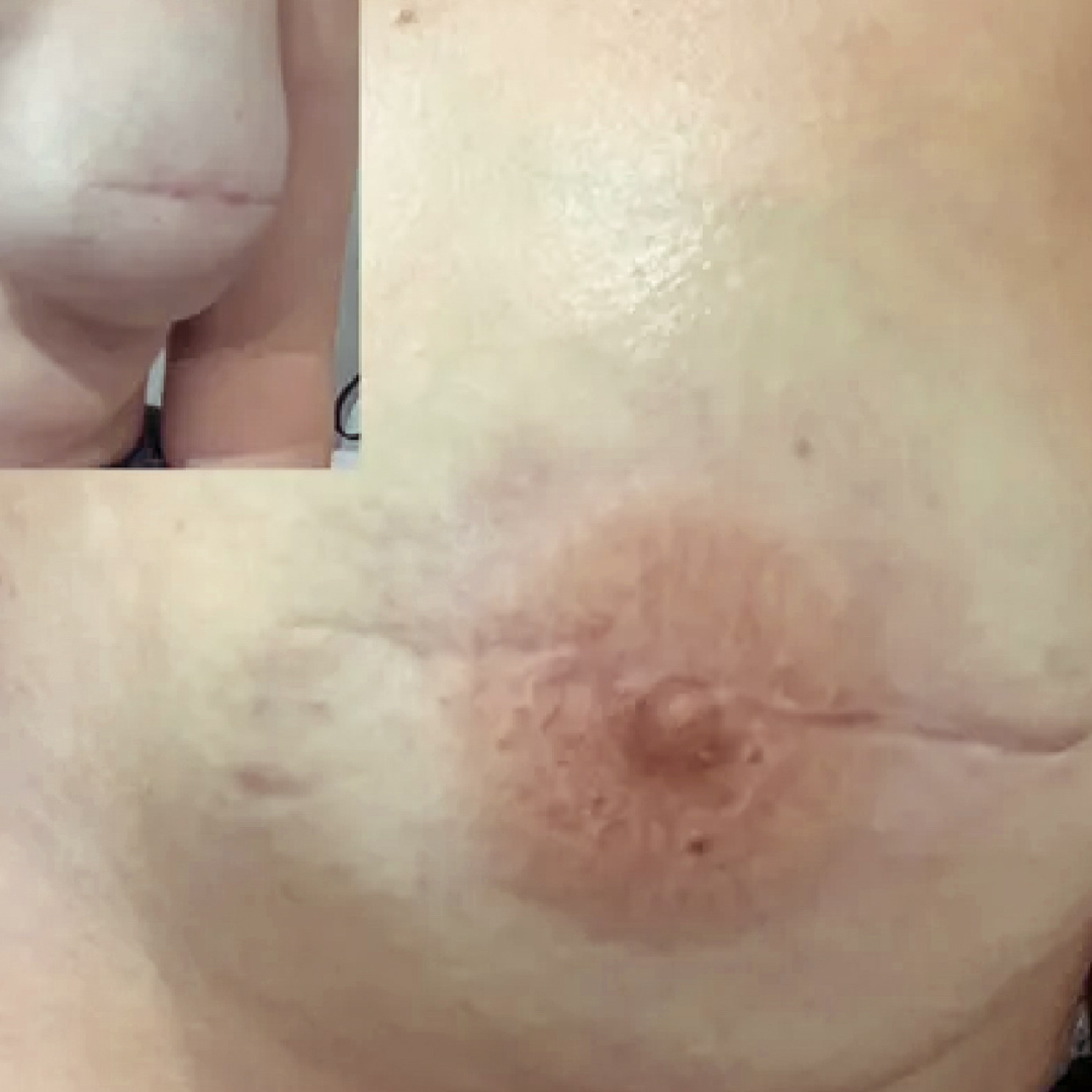 3D Areola Tattooing